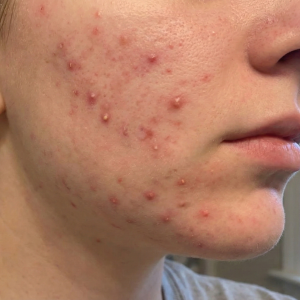 Acne Guide E-book